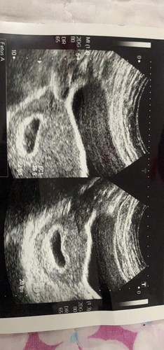 Pegi klinik buat ultrasound doc kata ada kantung tapi baby tak nampak. Masa tu dah masuk 6week. Ada yg pernah alami ?