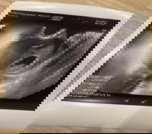 ถุงตั้งครรภ์แบบนี้ผิดปกติรึป่าวคะ