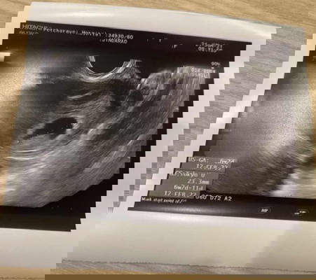 ถุงตั้งครรภ์แบบนี้ผิดปกติรึป่าวคะ