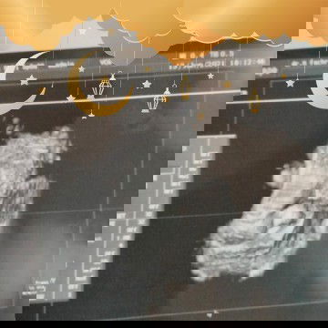 di uk 27w diagnosa previa dan di 35w plasenta sudah normal ❤️❤️