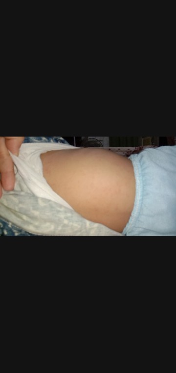 Cara mengatasi campak pada bayi
