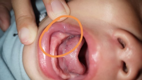 Teething or ulcer?