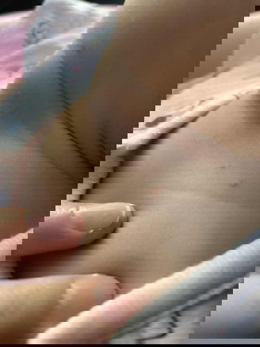 ตุ่ม ผด เม็ดๆ ที่ขึ้นที่ตัวลูกน้อยวัย 6เดือน+