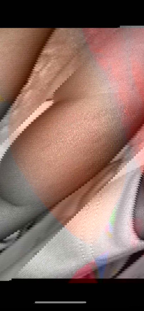 ปัญหาผิวลูกน้อย