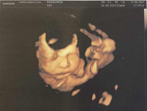 32 wk. 2,500 g.