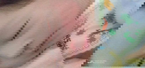 Bunn,, saya mau tanya nih kalau pipi bayi merah" seperti ini kenapa yaa Bun? Dan obatnya apa? Trims