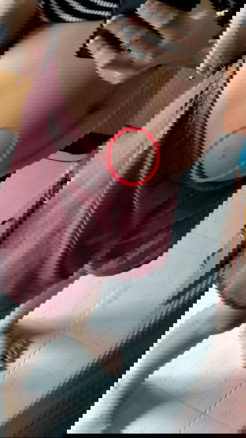 รอยแตกใช่ไหมค่ะแม่ๆๆ