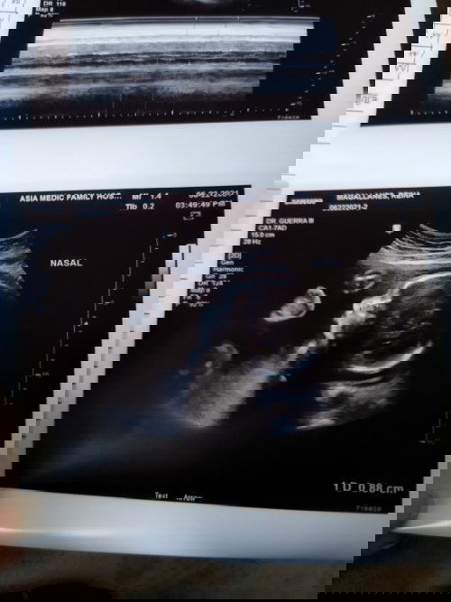 CAS Ultrasound - Nakadapa si Baby