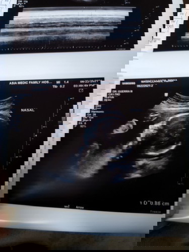 CAS Ultrasound - Nakadapa si Baby
