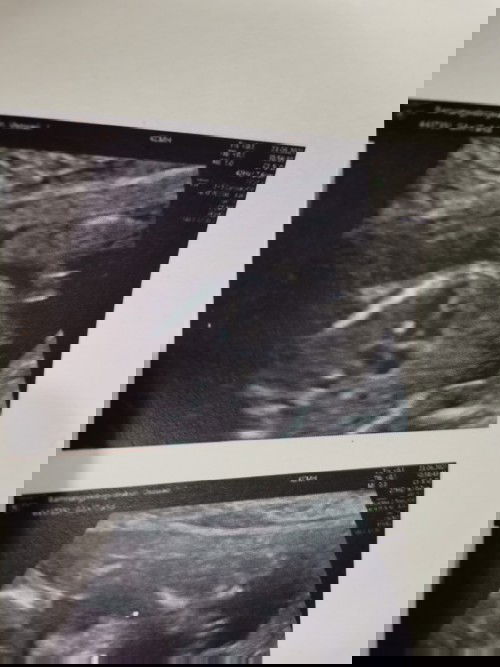 อายุครรภ์​ 19​ สัปดาห์
ไปตรวจอัลตร้าซาวด์  หมอ​บอกเจอแคลเซียม​เกาะหัวใจ​น้อง​