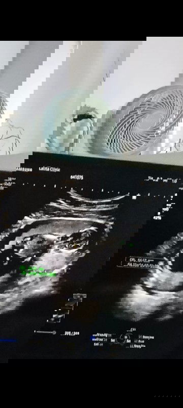 กำหนดคลอดตัวเล็ก