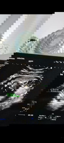 กำหนดคลอดตัวเล็ก