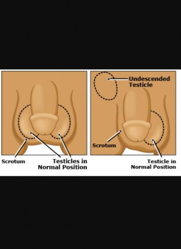 Undescended testicle