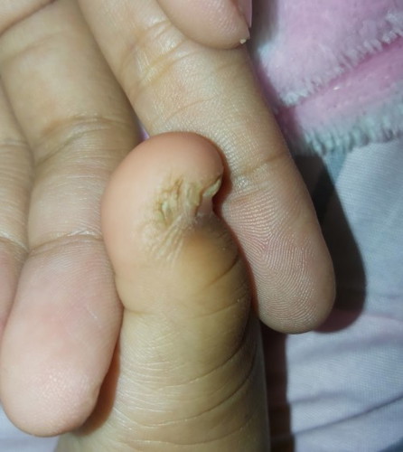 Baby toe callus?