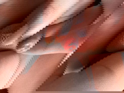 แบบนี้เรียกว่าเป็นอะไรค่ะ พอดีจะเปลี่ยนแพมเพิสให้ลูกแล้วเห็นเป็นแบบนี้ค่ะ