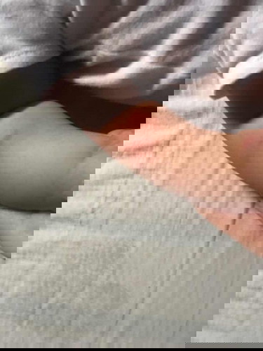 Insect bites