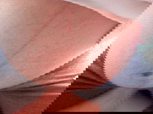 ใครเคยเป็นผื่นคัน