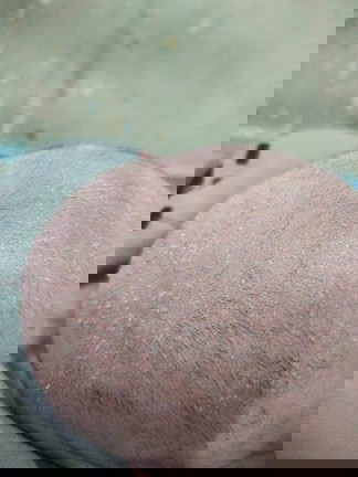 หัวทารถเป็นขุยๆ