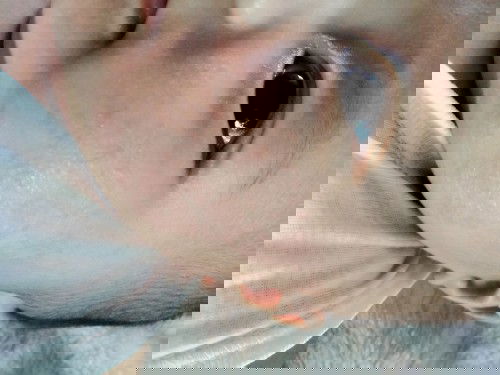 ผื่นแบบนี้อันตรายไหม