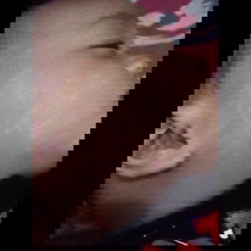 Bercak putih di pipi