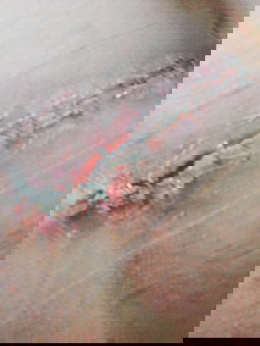 CS incision opened causes pain and foul smell