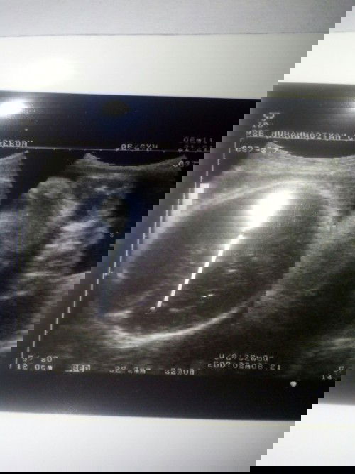 Wkt mnggu llu aku USG usia kndungn 8w bert janin 1700grm normal kah