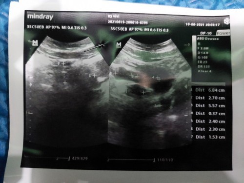 Mau tanya klau hasil nya seperti ini artinya?kata dokter seltelur nya udh besar,apa itu hanya seltlr