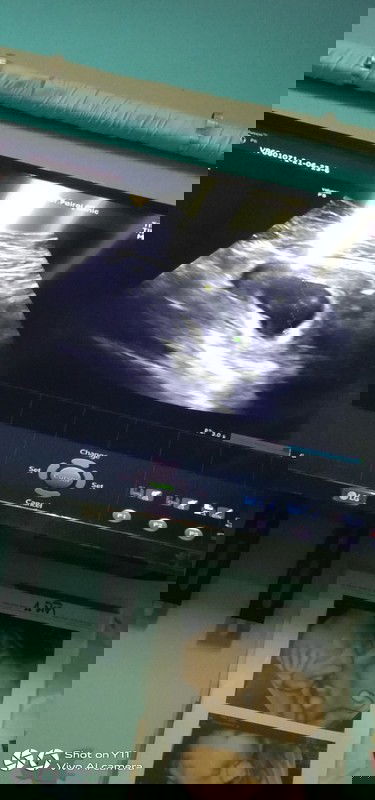 แบบนี้คือท้องลมหรือคะช่วยตอบทีค่ะเครียดมากๆเลย😔🙏