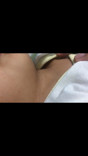 Rashes ni baby