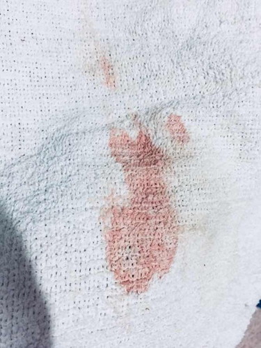 Bleeding at 20weeks pregnancy after sex sino po nka experience yan lng po ung dugo then hindi na xa nag continue 