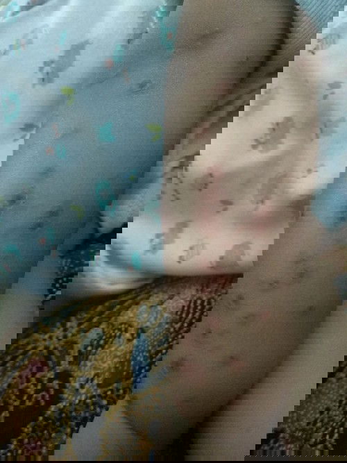 Kulit bayi tertular kena bakteri
