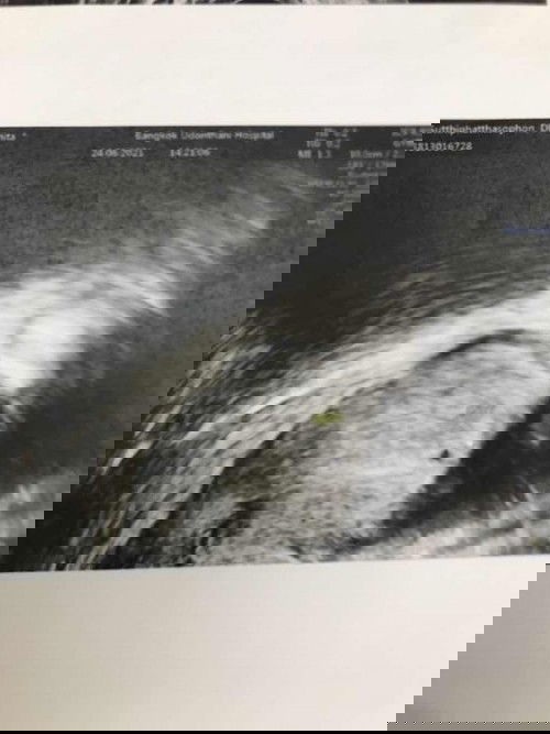 ตัวอ่อนไม่พัฒนา 💔😭