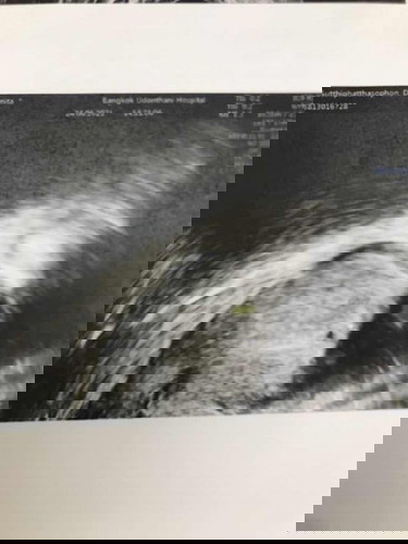 ตัวอ่อนไม่พัฒนา 💔😭