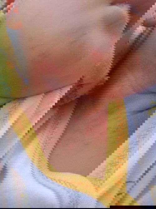 Bintik merah di leher bayi