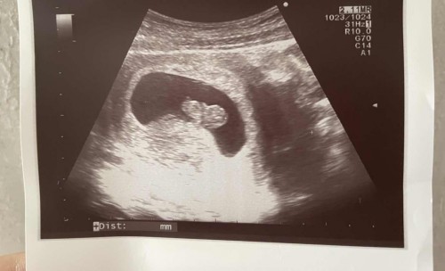 Week 9 ultrasound