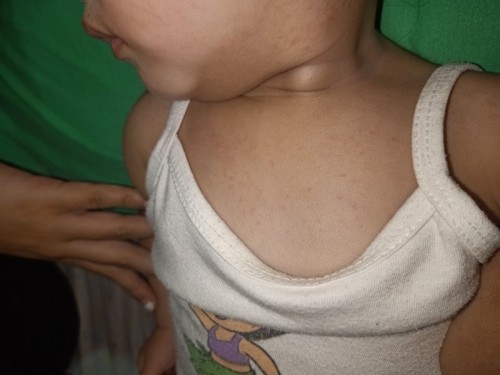 Rashes ni Baby