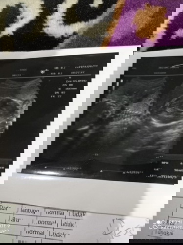 plasenta (ari ari di bawah )usia kandungan 26 week apakah bahaya atau tidak ?