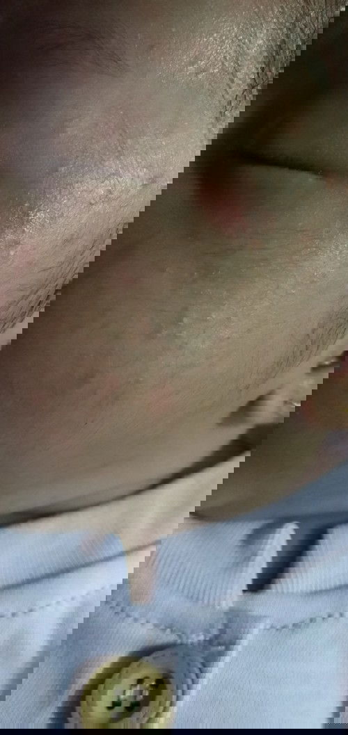 wajah bayi beruntusan merah2