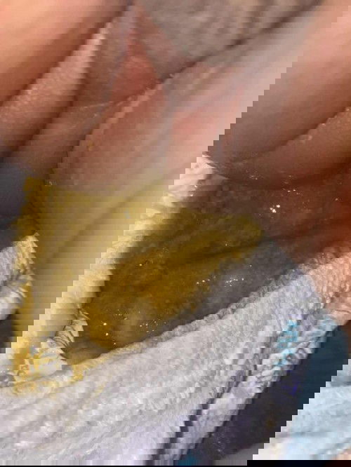 แบบนี้ท้องเสียไหมค่ะมีงอแงนิดหน่อย