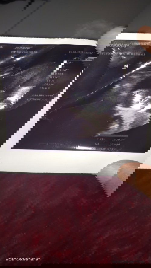 Hamil 11 w 4 d berat janin 100gr