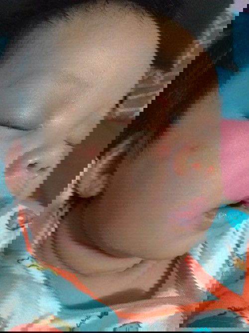 ขอสอบถามผู้รู้หน่อยค่ะ ตุ่มขึ้นเเบบนี้คือตุ่มอะไรค่ะ น้องคลอดมาได้29วันพึ่งเป็นวันนี้ค่ะเเอบกังวล