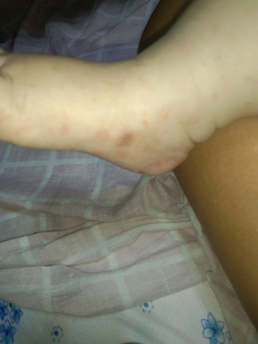 Itchy skin on baby