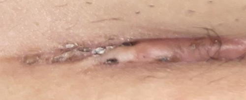 Parut Keloid Czer