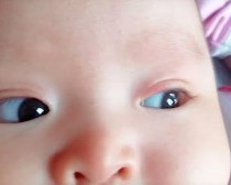 Vết đỏ mí mắt trẻ sơ sinh.