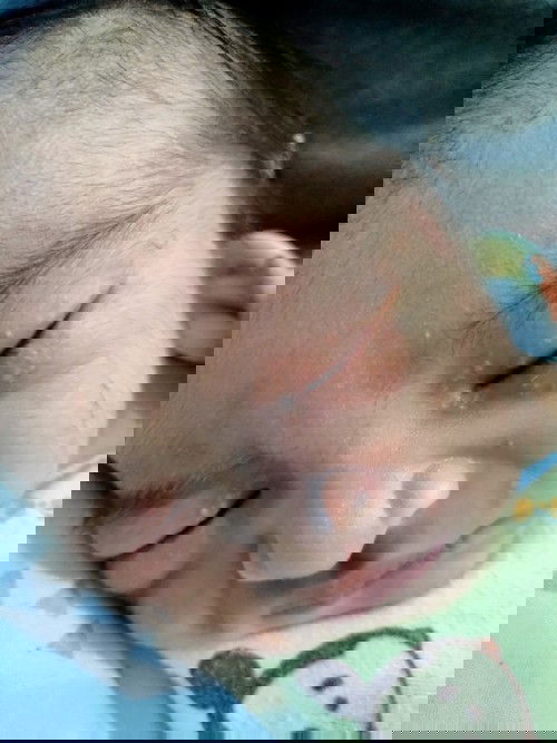 Bruntusan pada wajah bayi