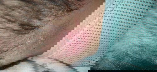 GATAL DIBELAKANG LEHER