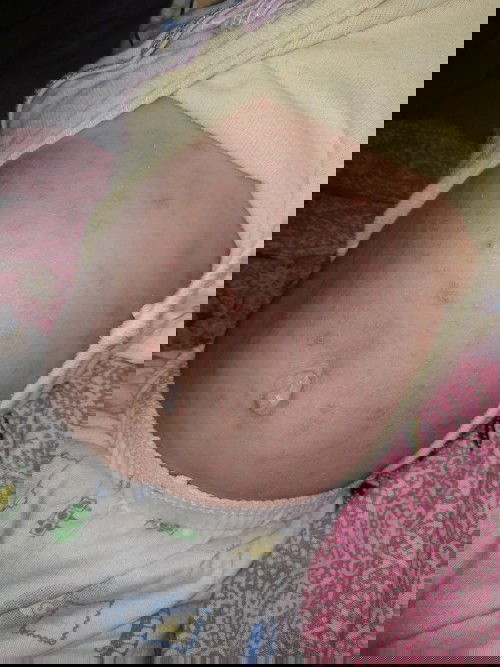 Bentol merah - merah