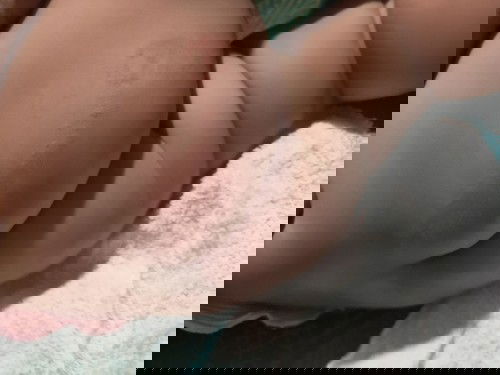 Mong bé bị như này thi mua thuốc j bôi vậy ạ