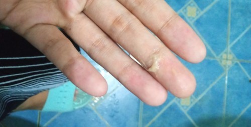 After bleeding