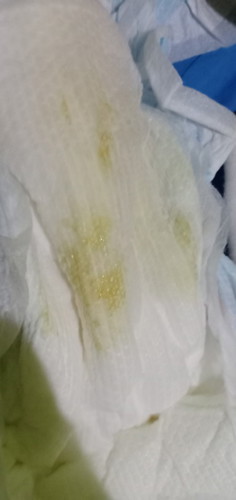 Baby vaginal discharge